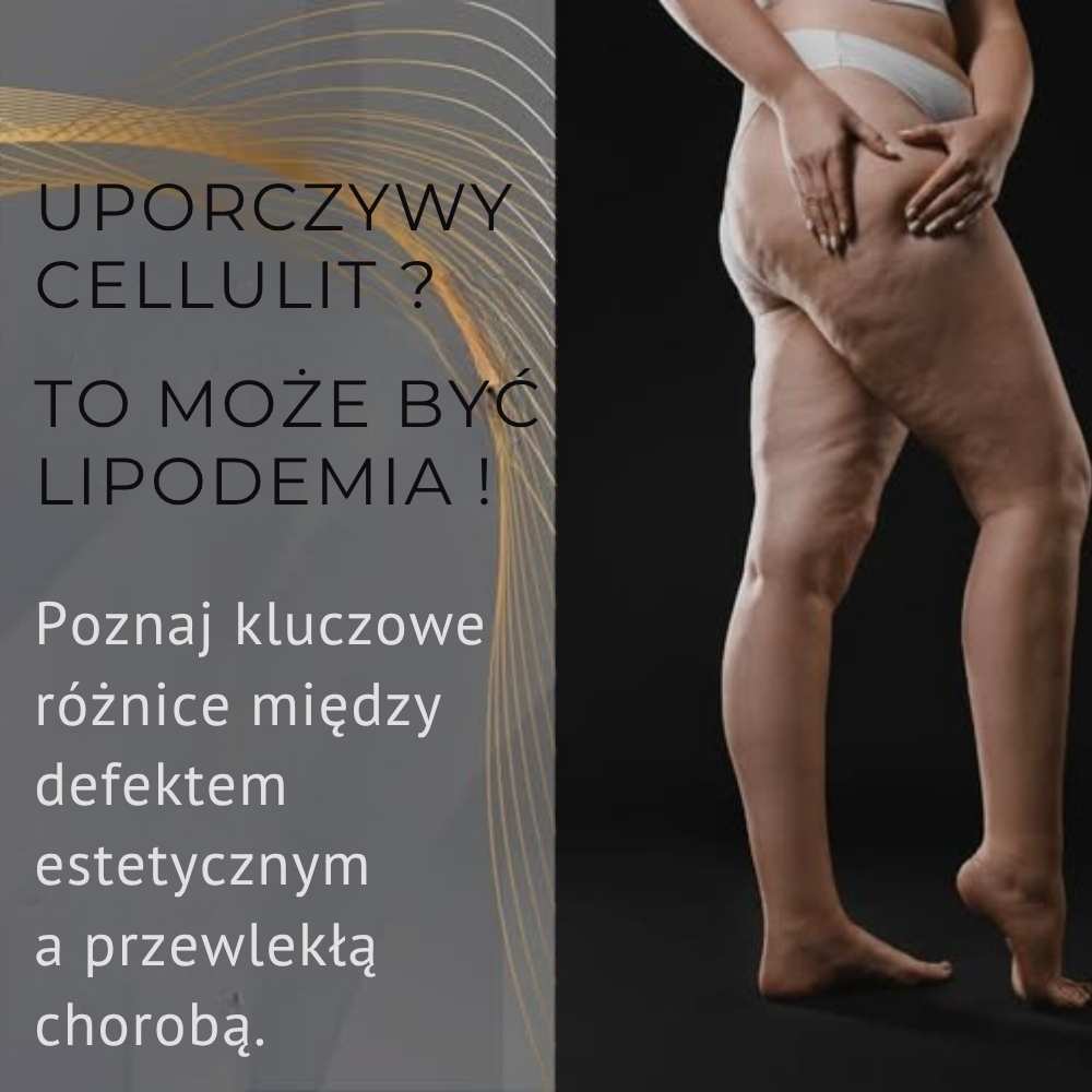 Cellulit czy lipodemia? Jak odróżnić defekt kosmetyczny od choroby układu tłuszczowego